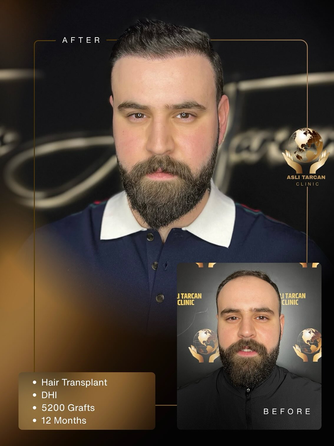 ✨ “New hair, same DNA — reprogrammed.”
This transformation wasn’t just cosmetic — it was cellular.
At Aslı Tarcan Clinic, we don’t just implant grafts.
We decode scalp behavior, map blood flow, analyze root angle memory, and reprogram follicular survival —
all through DHI precision and surgical artistry.
📌 5200 Grafts
📌 12 Months of Follicular Maturation
📌 Zero scars. Full confidence.
Because at Aslı Tarcan, it’s not about looking different —
it’s about looking like the version of you your genetics forgot to finish.
⸻
#AsliTarcanClinic #HairScience #DHItransformation #HairReprogramming #ScalpBiology #ModernHairTransplant #GraftByGraft #HairDNA #IstanbulClinic #HairDesign #HairPrecision #AsliTarcanResults #FromScienceToStyle #HairClinicGlobal #hairtransplant