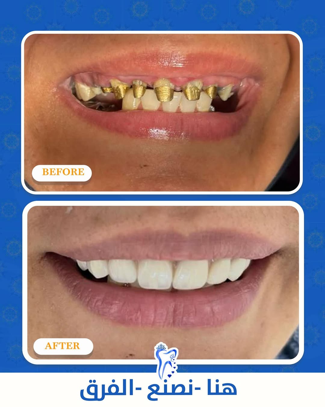 أبتسم بثقة وكن صاحب ابتسامة مثالية
✅ تقنيات حديثة ✅ فريق خبراء ✅ نتائج طبيعية مضمونة.
متواجدين لخدمتكم طيلة أيام الأسبوع
#الشركة_الطبية_العالمية #ابتسامة_مثالية #تجميل_الأسنان #صحة_الفم #جمال_الابتسامة #عالمية_الطبية #ثقة_جديدة #ابتسامتك_هويتك
موقعنا .. البصرة المطيحة مجاور مدارس الفراهيدي
07737999944