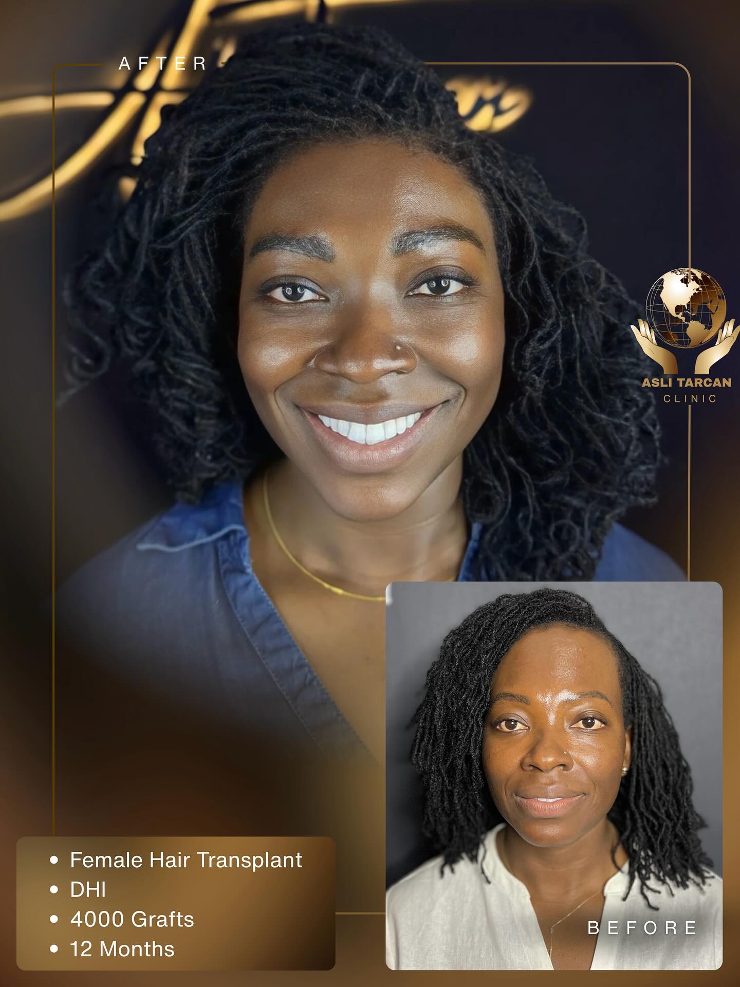 What Should You Know Before Getting an Afro Hair Transplant as a Woman? 🙋🏾♀️
Every hair type is unique but Afro-textured hair, with its tightly coiled structure, requires a specialized approach in hair transplantation.
step by step journey of a female patient with Afro hair, who underwent a 4000-graft DHI procedure with outstanding results.
Each slide answers a question you’ve probably had in mind.
✨Check out this amazing transformation achieved with our Forehead Reduction procedure:
• Graft Amount: 4000
• Method Used: DHI
• Month: 12 Months
Ready to achieve your dream hair?
Visit our website and get your free online consultation today.
📱 WhatsApp: +90 549 620 15 40
✉️ Email: info@aslitarcanclinic.com
🌐 Website: www.aslitarcanclinic.com
⸻
#afrohairtransplant #femalehairtransplant #afrohairrestoration #curlyhairtransplant #blackhairtransplant #hairtransplantforwomen #dhi #dhimethod #4000grafts #12monthresults #hairlinecorrection #naturalhairtransplant #beforeandafterhair #hairtransformation #aslitarlanclinic #hairgoals #hairtransplantturkey #realresults #afrohairjourney