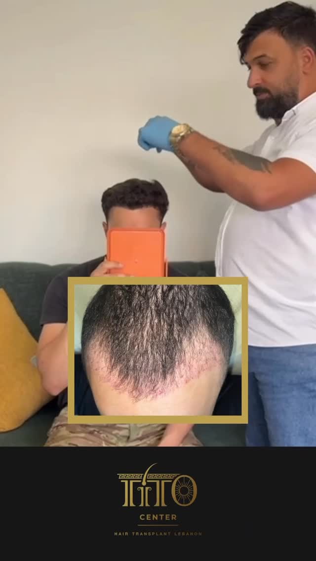 صيفك هالسنة غير
مع زراعة شعر مضمونة ومثبتة بشهادة رسمية
نتائج طبيعية بأسعار مدروسة وتقنيات متطورة
احجز استشارتك المجانية اليوم
This summer, make the change
Certified and guaranteed hair transplant with natural results
Advanced techniques at studied prices
Book your free consultation today
#Titocenter #HairTech #HairTransplant #AdvancedTechnology #NaturalHair #HairRestoration #CertifiedResults