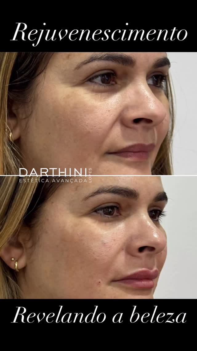 Não é sobre mudar quem você é, é sobre revelar o melhor da sua beleza: protocolos inteligentes para um rejuvenescimento leve e elegante.
Harmonização labial sutil: realce o volume natural dos seus lábios sem mudar sua identidade — em uma única sessão.
Nossos protocolos personalizados de Harmonização Facial entregam:
✅ Olhar descansado
✅ Rosto mais firme
✅ Lábios simétricos e suavemente realçados
✅ Contorno facial mais definido
...sem perder sua essência 💆♀️💖
Transforme seu rosto com um plano totalmente personalizado para suas necessidades: descubra como destacar sua beleza real sem exageros.