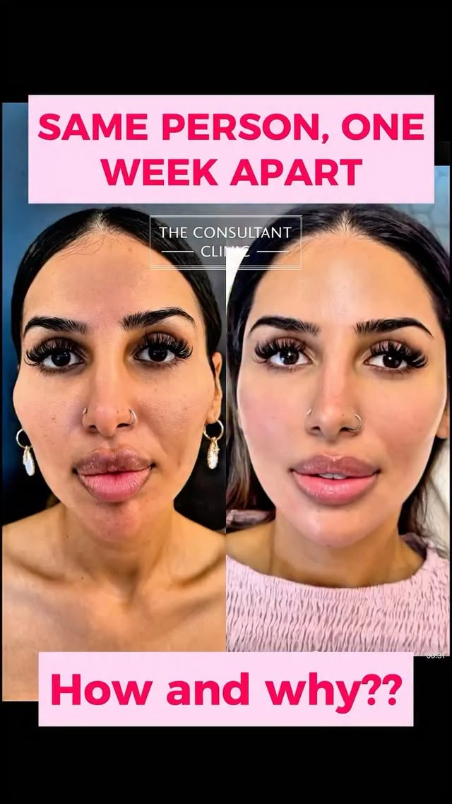 ✨One. Week. Apart.✨
Yes—just seven days, nearly 8000 units of dissolver, and a full rethink of how filler should be done.
This absolutely stunning Indian bride-to-be came to us in wedding countdown crisis mode. Her big day is in October, but her face had been hijacked by overfilled chaos.
Revolax had carved out such unnatural harsh cheek ledges that it actually made her temples appear far more hollow—a total optical illusion from bad placement. Her chin was unnaturally pointy and boxy at the same time (don’t ask us how), and her lips were so overfilled they looked like they might float off mid-convo.
Her delicate features were completely overwhelmed. But underneath? Absolute supermodel . She’s breathtakingly beautiful.
So we hit reset:
✔️ Dissolved everything (nearly 8000 units (!!), for the curious).
✔️ Rebuilt using just 10ml of @maili_uk premium filler—and no, we don’t get paid to say that. We just don’t mess around with cheap product when we’re sculpting faces.
💉 Natural, soft lips—not migrating sausages
💉 A chin that sculpts—not stabs
💉 Lifted, full temples—not sunken shadows
💉 Balanced, glowing bridal beauty—not back-alley filler roulette
Your face isn’t the problem.
Your injector might be.
Good filler elevates you. Bad filler and an overzealous hides you. It’s more expensive to choose 20 years of doctors experience (Dr Gareth here), with hundreds of thousands of patients behind them, and different modalities and ologies of filler crafted in different layers to perfectly mimic and enhance your anatomy.
But the results are head turning different, and there’s a reason for that. #consultantclinic
Choose wisely
