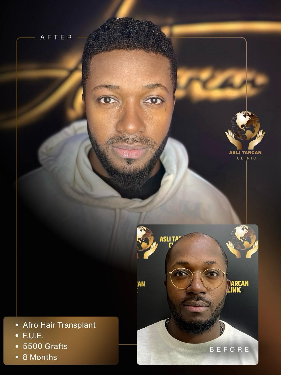 What Should You Know Before Getting an Afro Hair Transplant as a Man? 🙋🏾♂️
Every hair type is unique but Afro-textured hair, with its tightly coiled and dense structure, demands a precise and specialized technique for hair transplantation.
Each slide in this carousel answers the most common questions you may have.
✨Check out this powerful transformation achieved with our Afro Hair Transplant procedure:
• Graft Amount: 5500
• Method Used: FUE
• Result Time: 8 Months
Want to restore your hairline with a natural and dense result?
Get your free online consultation now!
📱 WhatsApp: +90 549 620 15 40
✉️ Email: info@aslitarcanclinic.com
🌐 Website: www.aslitarcanclinic.com
⸻
#afrohairtransplant #malehairtransplant #afrohairrestoration #curlyhairtransplant #blackhairtransplant #hairtransplantformen #dhi #dhimethod #5500grafts #8monthresults #hairlinecorrection #naturalhairtransplant #beforeandafterhair #hairtransformation #aslitarlanclinic #hairgoals #hairtransplantturkey #realresults #afrohairjourney