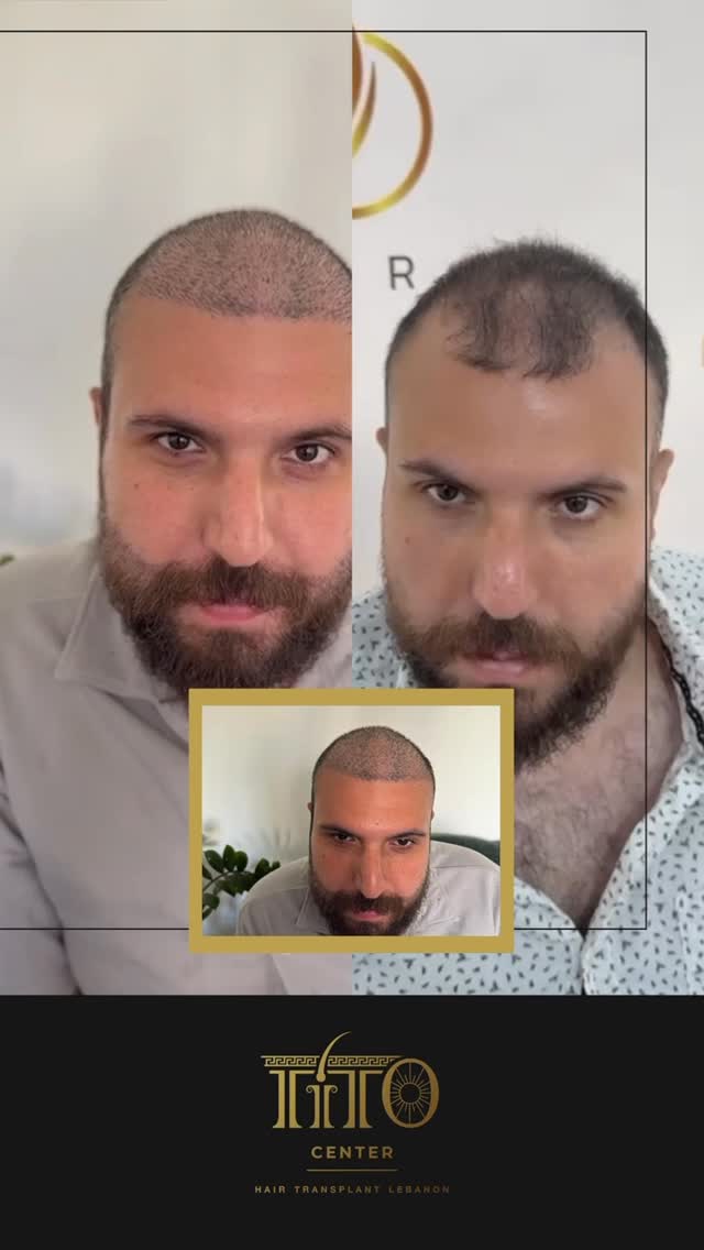 رأسك ولحيتك… تغيّروا بيوم واحد!
زراعة شعر الرأس واللحية بجلسة وحدة، ونتائج تحكي عن حالها.
تقنيات دقيقة، تغطية كاملة، وشهادة ضمان من تيتو.
نحنا ما بنحكي كتير… الصور بتكفي.
احجز استشارتك المجانية اليوم، وخلي التغيير يبدأ من هون
Scalp and beard—transformed in one session.
Full coverage hair + beard transplant with guaranteed results.
Advanced precision. Natural look. Certified by Tito.
We don’t say much… the results speak for themselves.
Book your free consultation today and start your transformation with us.
#TitoClinic #HairTransplant #BeardTransplant #BeforeAndAfter #OneSessionTransformation #NaturalLook #CertifiedResults #FreeConsultation
