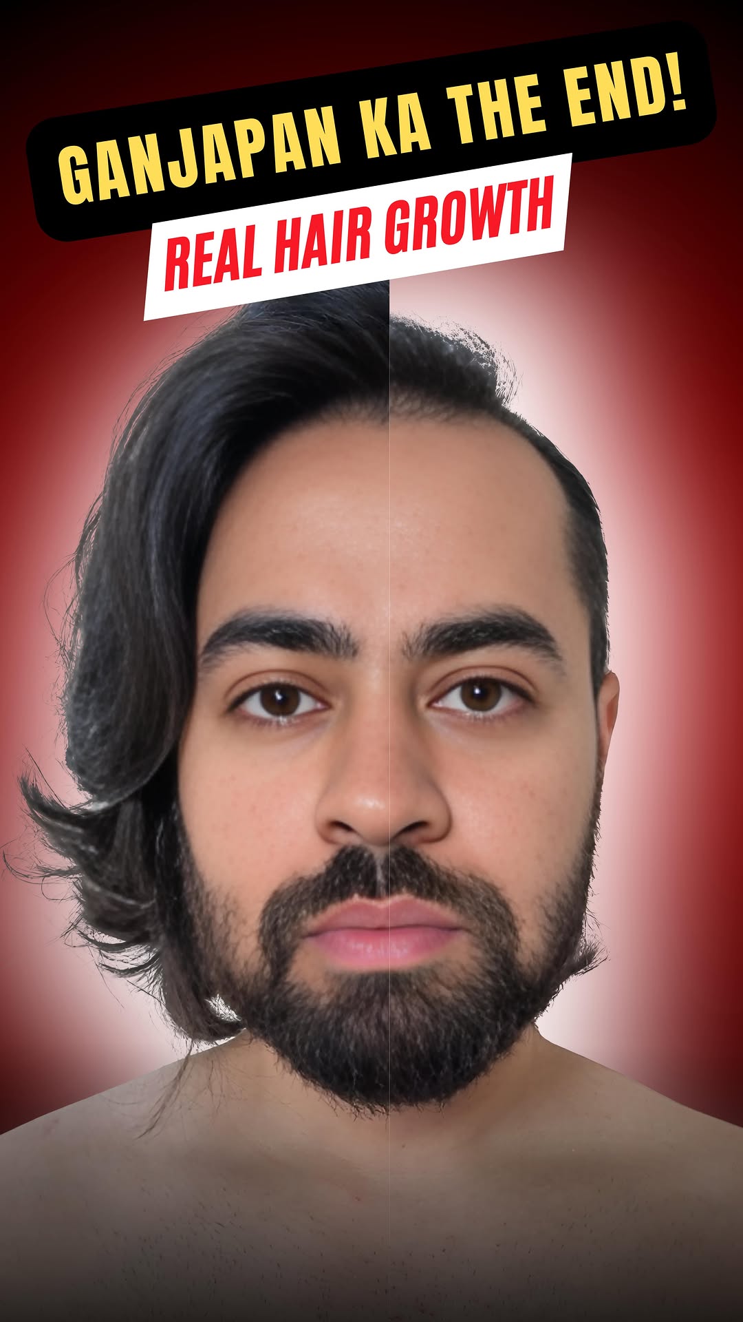 Comment “HAIR” for link or share this reel in my DM for link
Hairfall Ka Full Stop!💥 Rosemary + 3% Redensyl = New Hair Growth Miracle! | No Minoxidil Needed
Baal gir rahe hai? Aur lagta hai jawaani se pehle ganjapan aa raha hai? 😭
Toh bhai, totke bhool jao aur science wali remedy apnao! 🔬
Is video me baat ho rahi hai ek aise hair growth formula ki jo Minoxidil se zyada effective hai — bina side effects ke!
💪 Rosemary blocks DHT
🔥 3% Redensyl activates sleeping hair follicles
Aur is Bare Anatomy Advanced Hair Growth Serum me milte hai 7 active ingredients jo karte hai miracle-level regrowth!
✅ Hairfall Control
✅ Baby Hair Growth
✅ Stronger, Thicker Hair
✅ Scientifically Proven Ingredients
✅ No Itching, No Flaking
Baal lagate hi personality badal jaati hai!
Try karo aur khud difference feel karo!
📲 Ya is video ko kisi dost ko bhejo jiska scalp help ke liye chillaa raha hai!
Hairfall solution for men, rosemary oil for hair growth, redensyl serum review, how to regrow hair naturally, best hair growth serum, no minoxidil hair growth, DHT blocker rosemary, advanced hair serum India, bare anatomy hair serum, hair thinning solution, baby hair regrowth, baldness solution for men, haircare for men India, hair growth without side effects, head2toe hair tips, 3% redensyl benefits, male pattern baldness remedy, hair fall recovery journey, hair serum that works, Indian grooming tips
#HairFallSolution #HairRegrowth #RosemaryOil #Redensyl #BareAnatomySerum #HairCareForMen #ThickerHair #StopHairFall #MenGroomingIndia #BaldingSolution #MensHairCareRoutine #Head2ToeCare #ScienceBasedHairCare #hairgrowthtips