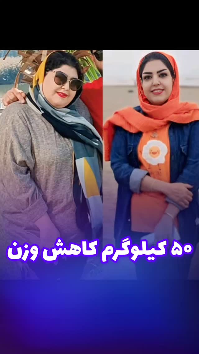 نتیجه جراحی بای پس بیمار عزیزم بعد از یک سال و نیم و کاهش ۵۰ کیلوگرمی😍
👨🏻⚕دکتر محمد عیدی متخصص جراحی عمومی و عروق فوق تخصص جراحیهای اندوسکوپی و چاقی
📍کاشان، خیابان بهشتی، بالای داروخانه قریشی، ساختمان اردیبهشت طبقه ۳
☎️ 031-55584207
🆔 @dr.mohammad.eidy
🔷🔹🔷
🌐 http://dreidy.ir/
#جراحی_بای_پس#لاغری_سریع#چگونه_لاغر_شویم#جراحی_اسلیو