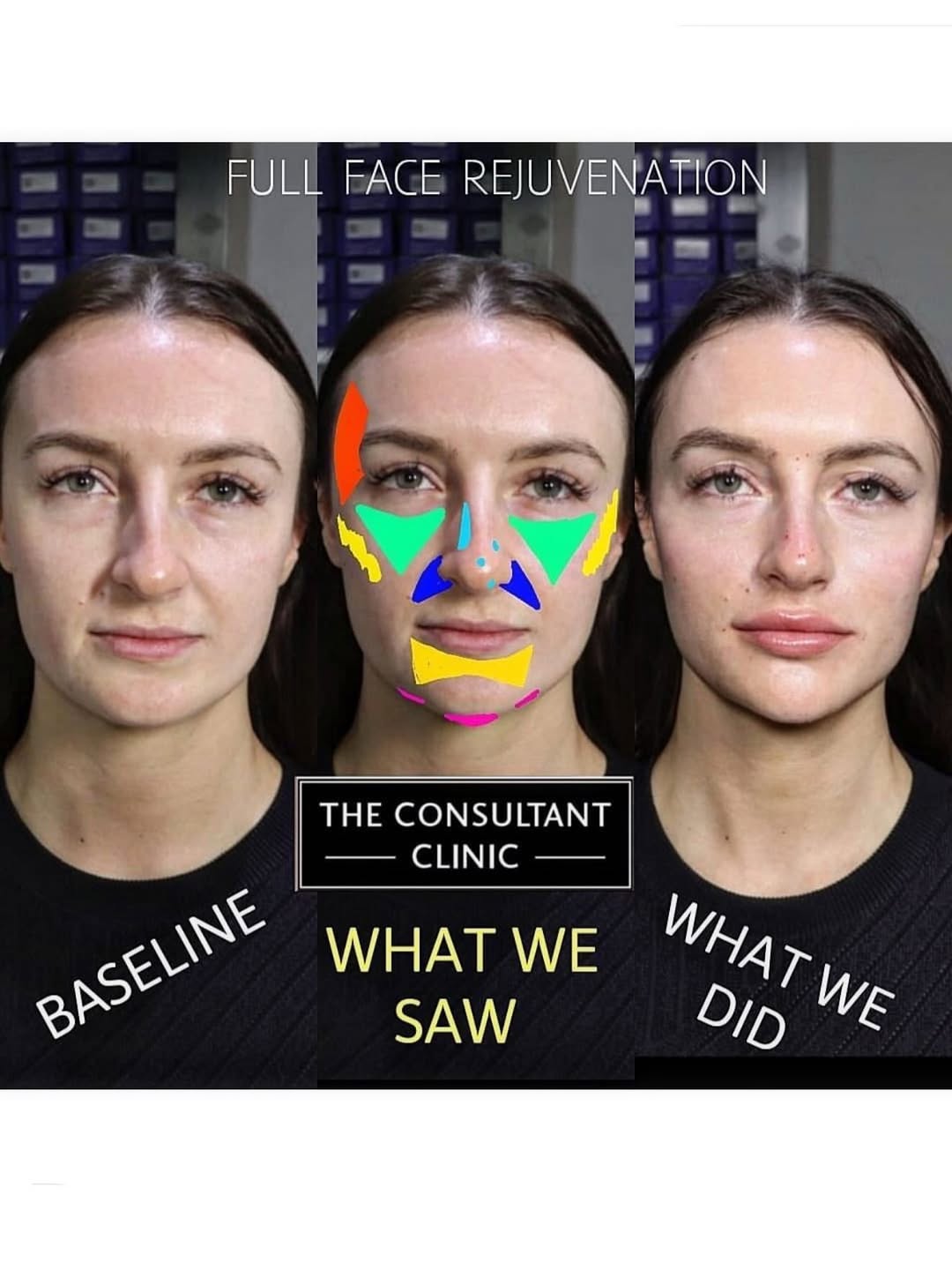 We don’t just show the front—we show every angle, every contour, and every drop of the Dr G 10ml magic. 💉✨
Because when the work is this good, you want people to look closely. Zoom in, flip it, reverse it—we’re proud of what we do.
This stunning patient travelled from Bristol for a full-face rejuvenation with Dr Gareth using multi-density, multi-modality filler techniques. From asymmetric temples and softening the jawline, to a liquid rhinoplasty, perioral finesse, and sculpted cheeks—every inch was planned to restore balance, not bulk.
No balloon faces. No single-plane filler. Just strategic artistry that looks effortless—because that’s the hardest kind. But it’s also the most desired of all, so we’ve dedicated ourselves to being master of the same - for 16 years now.
🔁 Swipe for before/after.
📸 Proof from every angle.
👀 Still natural. Still her. Just the glow-up version she remembered.
Which view is your fave? Side? Front? “What we saw”?
😌🖤