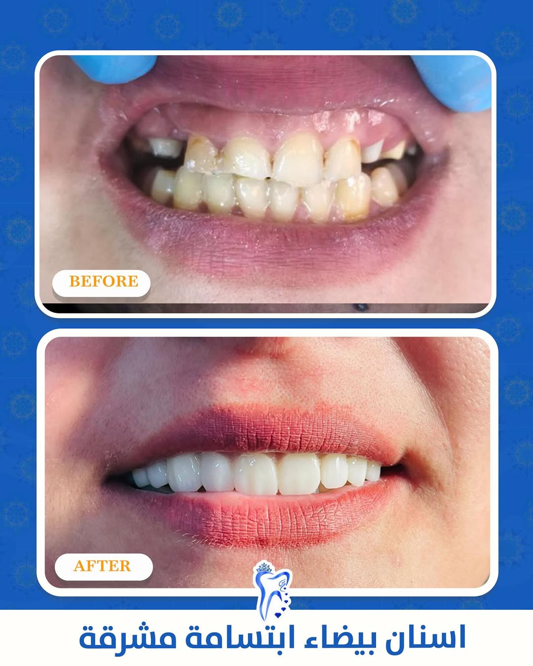  لأبتسامة جميلة وأطلالة ساحرة تخطف الأنظار 😁😁😁
مالكم غير مراكز الشركة الطبية العالمية
✅دقة بالمواعيد
✅️إتقان بالعمل
✅️ نظام بالتقسيط
#ابتسامة_هوليود #تقويم_الأسنان #تبييض_الأسنان #طب_الأسنان #جمال_الابتسامة #مراكز_الشركة_الطبية_العالمية #صحة_الفم #عناية_بالأسنان
موقعنا .. مركز البصرة التخصصي
البصرة المطيحة مجاور مدارس الفراهيدي
07737999944