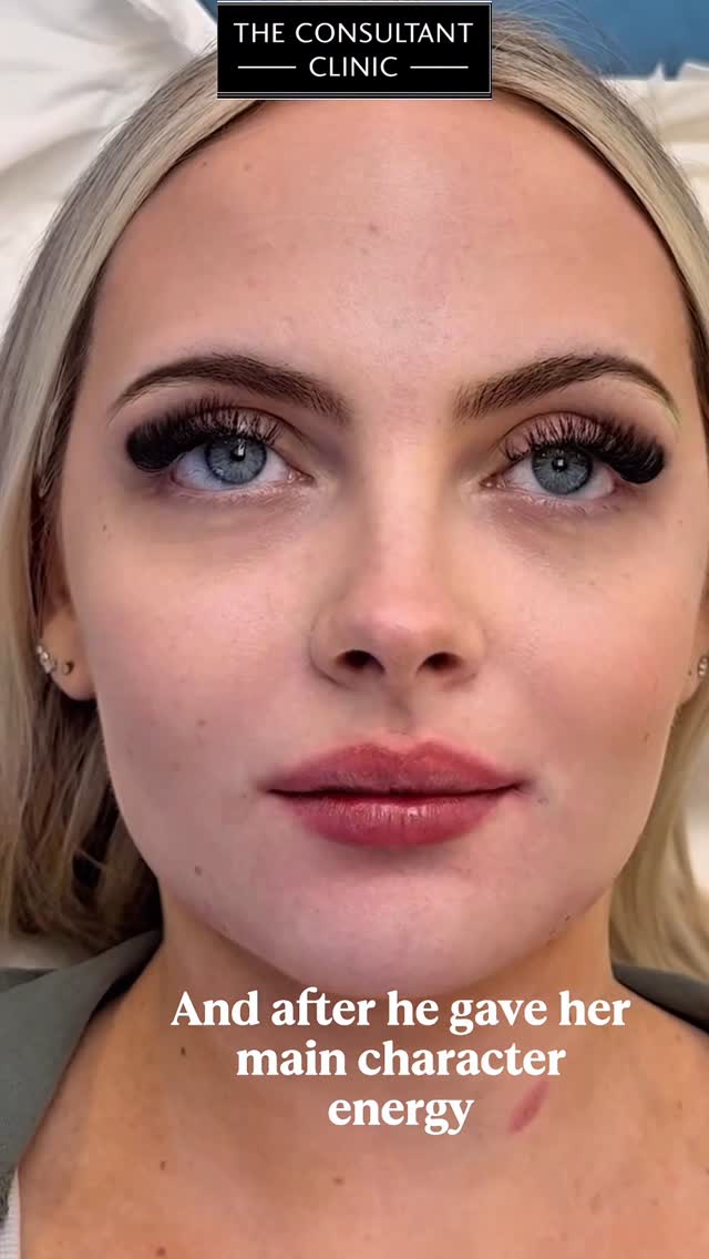 She came in asking only about her lips — but we saw the bigger picture (don’t worry, so did she… eventually 👀).
This absolute sweetheart had saved up and said if she was ever getting anything done, it was going to be with us — and we don’t take that kind of trust lightly. So, in the expert hands of the glow up whisperer himself - Dr Gareth at our Wilmslow clinic, we used just 4ml total to subtly tweak multiple areas: as well as a soft contour for the chin and jaw… and boom 💥 the glow-up she didn’t even know she needed.
No puffiness, no pillow face, no drama. Just smarter placement, better balance, and a face that looks like it finally caught up on eight hours of sleep and a decade of hydration. She was already gorgeous, we didn’t change her. Just polished the diamond.
💉 Proof that it’s not about how much you do — it’s about where and how you do it.