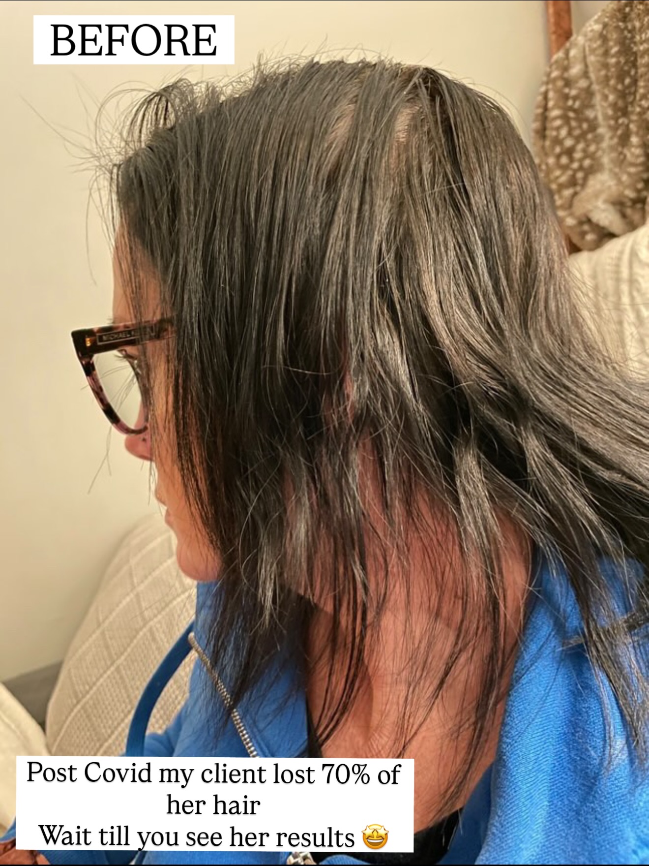 I absolutely LOVE her journey!!!! ❤️
She’s been using Amazing Hair Saviour now for over a year 😘
Ideally I advise twice a week. Either overnight or for a few hours.
Let’s get growing
#hairlossjourney #hairlosssolution #hairloss #hairgrowth #hairtransformation #hairgrowthtips #amazinghairsaviour