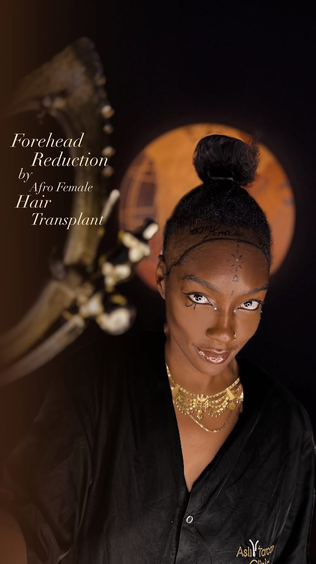 🎥 “The moment Cleopatra played… the decision was already made.”
Not just hair —
But identity, reborn.
4500 grafts.
A fearless Black queen, reclaiming her crown.
In the hands of FUE precision.
In the heart of Aslı Tarcan.
She didn’t just change her look —
She remembered who she was.
🖤 Real power doesn’t scream. It grows — silently, beautifully.
Contact Us Through whatsapp either imessage at:
+90 545 839 62 05
https://aslitarcanclinic.com/female-hair-transplant-in-turkey/
#CleopatraMood #BlackQueenEnergy #HairRebirth #4500Grafts #FUEHairTransplant #BoldTransformation #AsliTarcanClinic #HairGoals #OwnYourCrown #ConfidenceInEveryStrand #BeautyIsPower #RealStories #HairJourney #BlackBeautyMagic #afrohairtransplant #hairtransplant