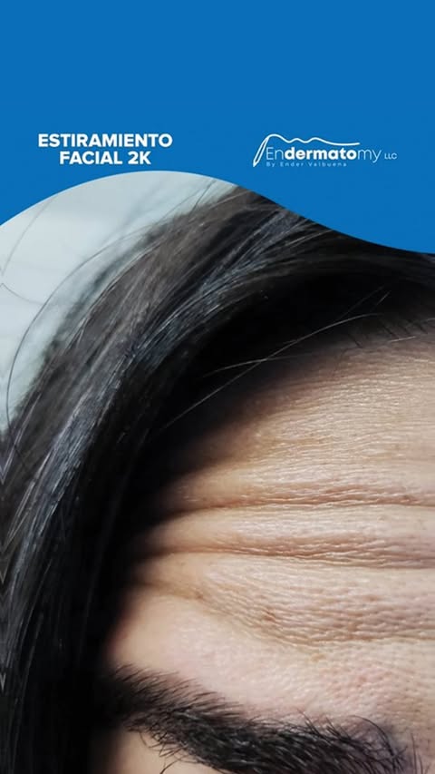 Luce un rostro de impacto con el tratamiento de Estiramiento Facial 2K, con el cual disminuyes las líneas de expresión marcadas y rejuveneces tu piel. Prepárate para lucir de impacto en el verano
Agenda tu cita a través del número:
786-930-0904
#piel #rejuvenece #tratamiento #estiramiento #facial #impacto #rostro #luce