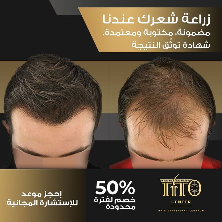 زراعة شعر بتقنية عالية ولمسة دقيقة
بأحدث الأجهزة وخبرة فريقنا الموثوق، منضمنلك نتيجة طبيعية بشهادة رسمية.
احجز استشارتك المجانية اليوم واستفيد من خصم ٥٠٪ لفترة محدودة!
Precision hair transplant with top-tier technology
We guarantee natural results with certified proof done by experts using the latest equipment.
Book your free consultation now and enjoy 50% off for a limited time!
#HairTransplant #HairRestoration #NaturalLook #CertifiedResults #AestheticClinic #HairCare