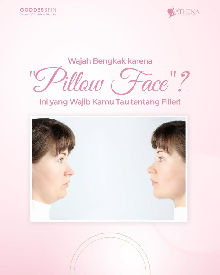 Efek Ketagihan Filler bisa bikin “Pillow Face"😱
Bukan makin cantik, malah bikin wajah bengkak nggak natural.
Makanya, pastikan filler kamu konsultasi dan ditangani oleh dokter profesional di klinik terpercaya ya agar kamu terhindar dari efek "Pillow Face" ini!✨