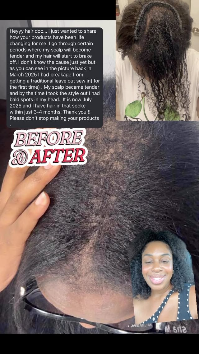 Ever wonder why those other products aren’t working for your scalp issues? It’s simple: most are watered down and lack the vital vitamins and minerals your scalp and hair need to truly help with conditions like hair loss, dandruff, psoriasis, dermatitis, and folliculitis.
But here’s where we’re different. Our products are formulated with the highest grade natural ingredients, packed with the essential vitamins and minerals your scalp and hair need. This powerful blend helps to prevent and eliminate psoriasis, dermatitis, hair loss, breakage, and significantly reduce shedding.
Comment the word “HELP” the check for the link in your DM OR click the link in my bio @atlantahairdoctor