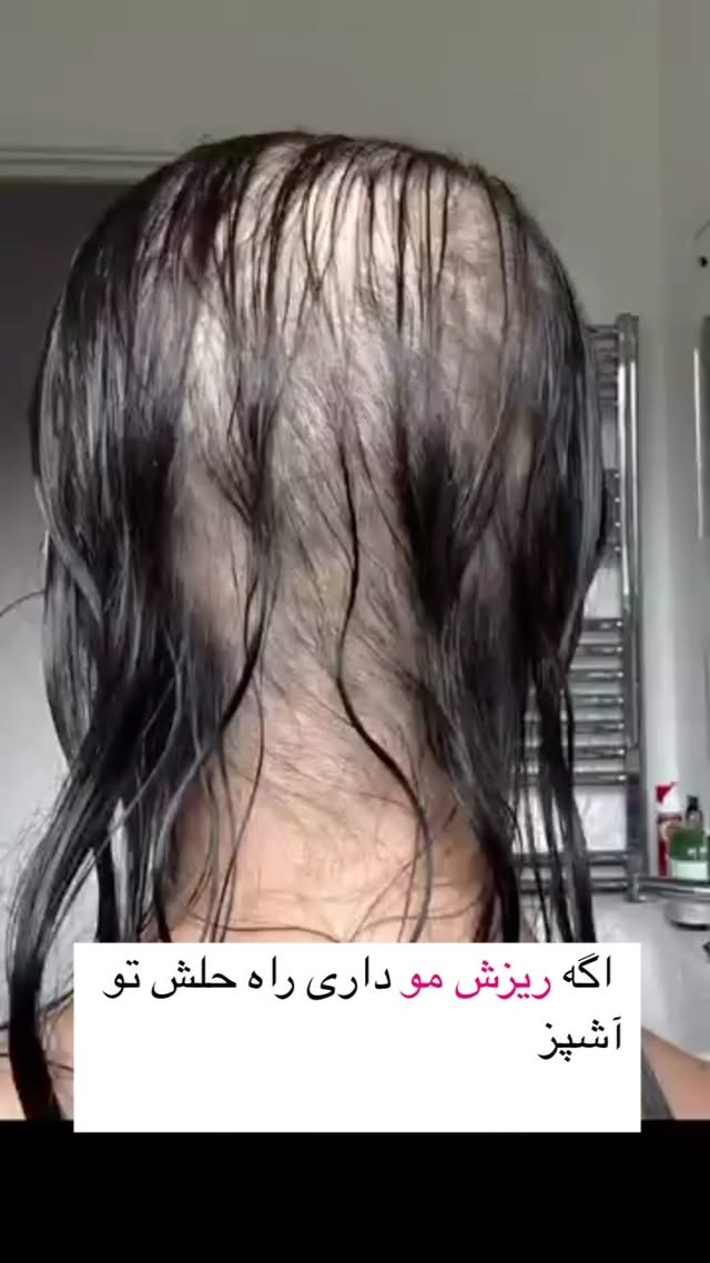 ریزش مو داری؟
راه حل تو آشپزخونهست!
با گیاه جادویی سیر چینی، ریشه موهاتو تقویت کن و جلوی ریزششو بگیر!
کافیه درست استفادهش کنی، تا فرقشو تو چند هفته ببینی!
اگه دنبال راههای طبیعی و گیاهی برای درمان مشکلات پوست و مو هستی،
همین الان یه سر به پیجم بزن و مطالب بیشتر رو ببین!
درمان با طبیعت شروع میشه… از همینجا!