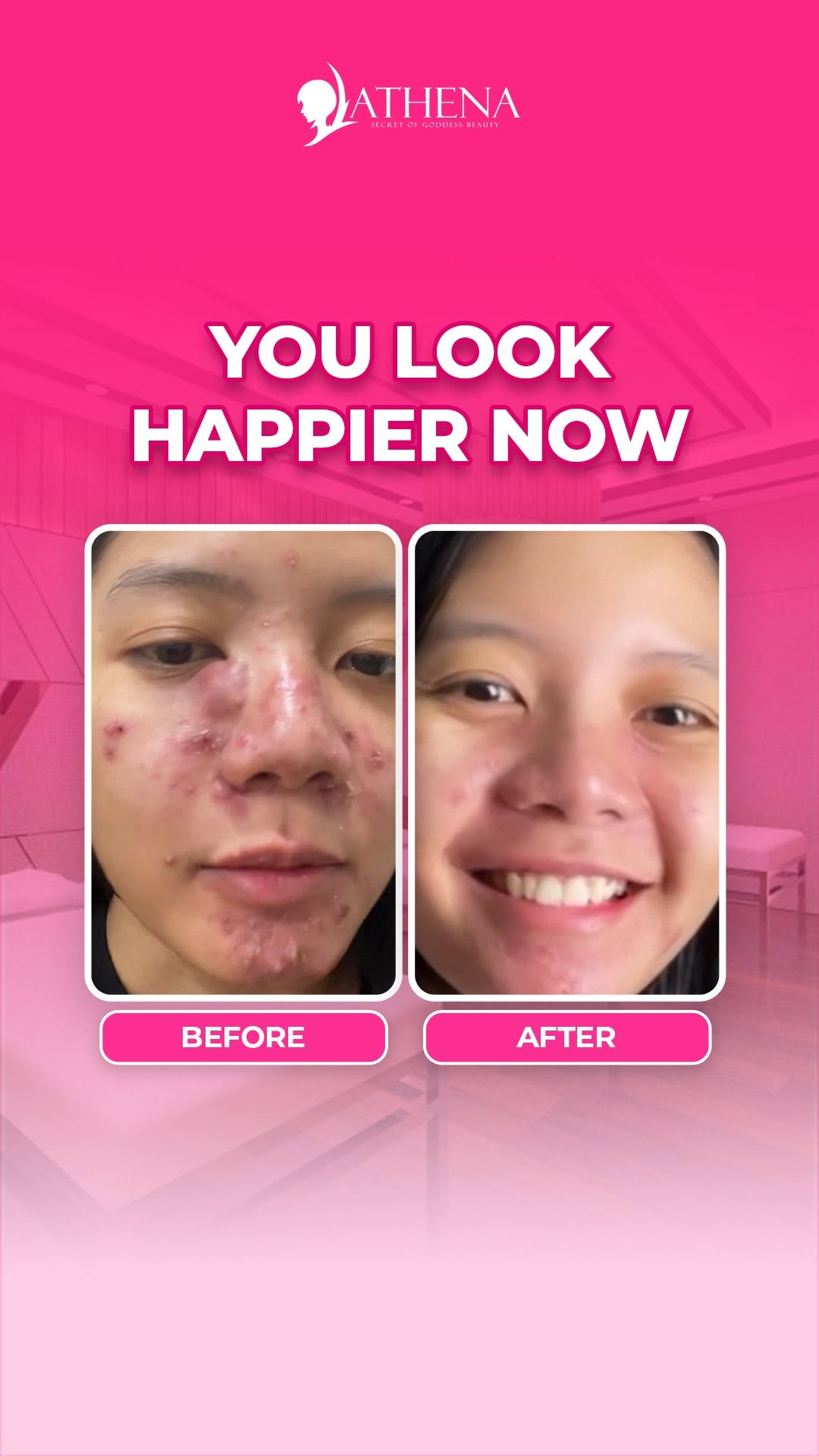 YOU LOOK HAPPIER NOW…
Ya iyalah! Setelah perjuangan panjang lawan jerawat, akhirnya bebas juga
Athena nggak cuma janji, tapi hasilnya nyata dan bikin percaya diri naik 100%!🤩💖