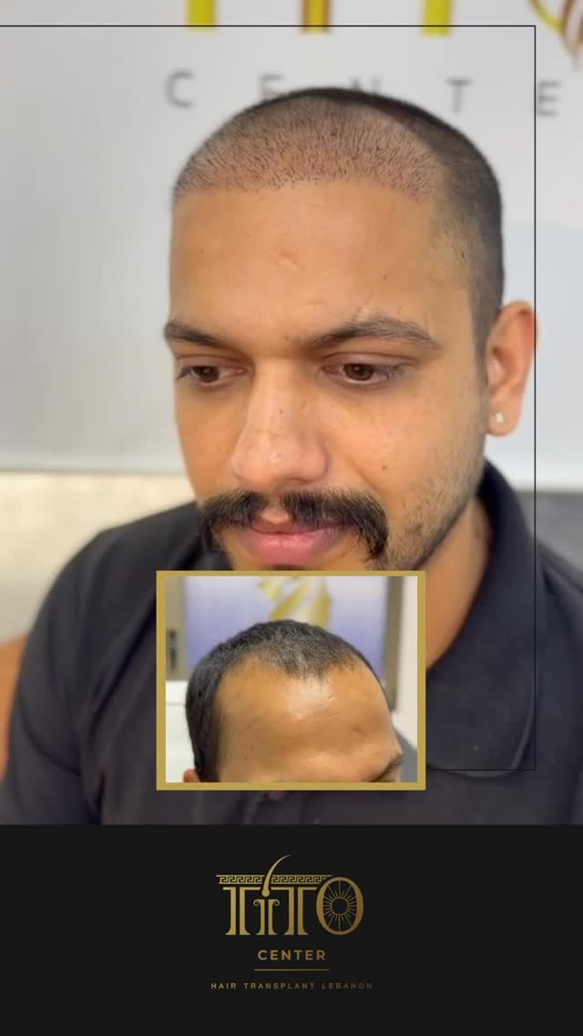 صيفك هالسنة غير
مع زراعة شعر مضمونة ومثبتة بشهادة رسمية
نتائج طبيعية بأسعار مدروسة وتقنيات متطورة
احجز استشارتك المجانية اليوم
This summer, make the change
Certified and guaranteed hair transplant with natural results
Advanced techniques at studied prices
Book your free consultation today
#Titocenter #HairTech #HairTransplant #AdvancedTechnology #NaturalHair #HairRestoration #CertifiedResults