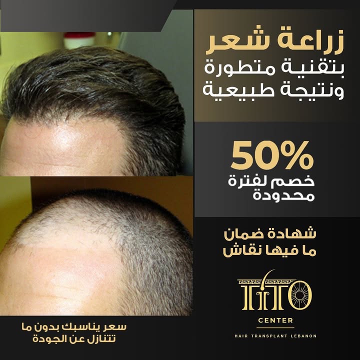 زراعة شعر بتقنية عالية ولمسة دقيقة
بأحدث الأجهزة وخبرة فريقنا الموثوق، منضمنلك نتيجة طبيعية بشهادة رسمية.
احجز استشارتك المجانية اليوم واستفيد من خصم ٥٠٪ لفترة محدودة!
Precision hair transplant with top-tier technology
We guarantee natural results with certified proof done by experts using the latest equipment.
Book your free consultation now and enjoy 50% off for a limited time!
#HairTransplant #HairRestoration #NaturalLook #CertifiedResults #AestheticClinic #HairCare