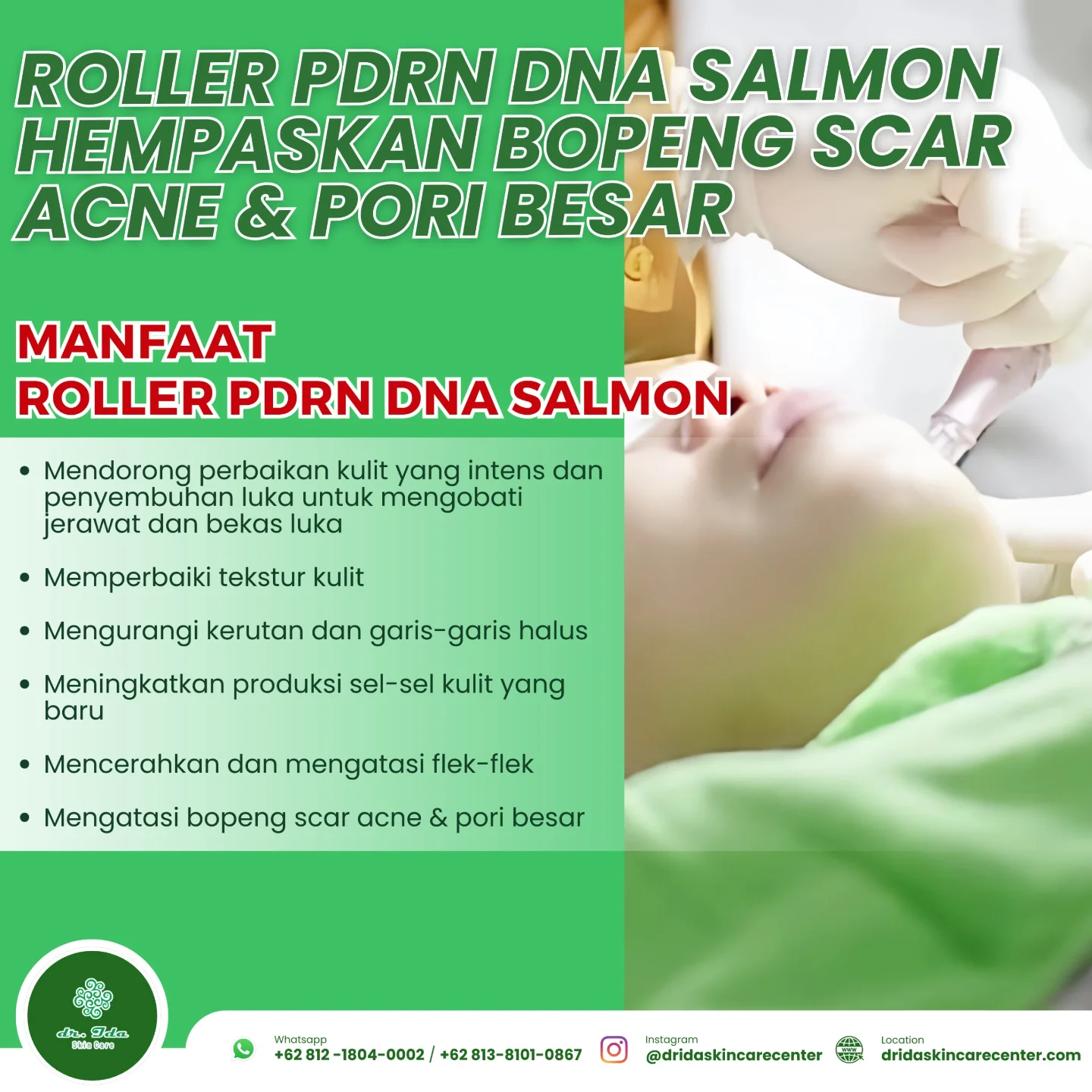 {ROLLER PDRN DNA SALMON}
PDRN (Polydeoxyribonucleotide) DNA Salmon adalah perawatan kecantikan yang menggunakan ekstrak DNA dari ikan salmon untuk meremajakan kulit.
PDRN, yang merupakan fragmen DNA, berasal dari sperma ikan salmon dan memiliki berbagai efek terapeutik seperti anti-inflamasi, dan regenerasi kulit.
Perawatan ini bertujuan untuk memperbaiki tekstur kulit seperti scar acne / bopeng bekas jerawat, pori - pori besar, mencerahkan, mengurangi kerutan, dan meningkatkan elastisitas kulit.
Promo bulan Juli :
1,5 Jt Diskon 35% jadi
975 K
Yuuuk jangan ditunda lagi untuk ambil treatmentnya, setelah tahu seputar treatment PDRN Salmon dan berbagai manfaatnya✨️🥳🎉⚘️🤗
#dridaskincare#klinikkecantikanbogor#produkamanbpom#perawatanwajah#rollerpdrnsalmon#pilihantreatmentbopeng#treatmentporibesar#treatmentflekbekasjerawat#bebasflek#bebaspporibesar#bebasscaracne#kulitsehat#kulitbersinar#kulitglowing#menyala