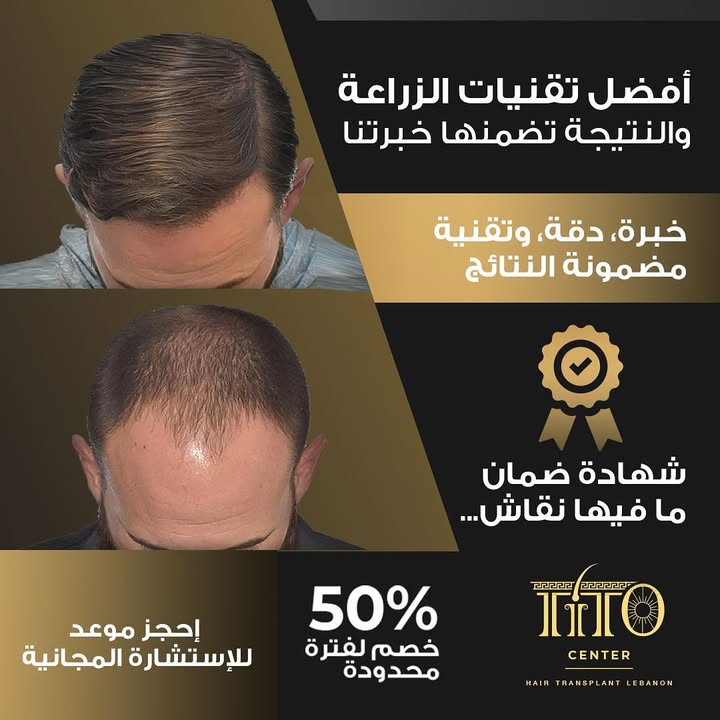 أفضل تقنيات زراعة الشعر، بنتائج مضمونة ومظهر طبيعي من أول نظرة. استشيرنا اليوم وابدأ التغيير.
The best hair transplant techniques with guaranteed results and a natural look from day one. Book your consultation now.
#HairTransplant #NaturalResults #HairRestoration #HairClinic #DHI #NoMoreHairLoss #ConfidenceBoost #BeforeAndAfter #HairJourney
