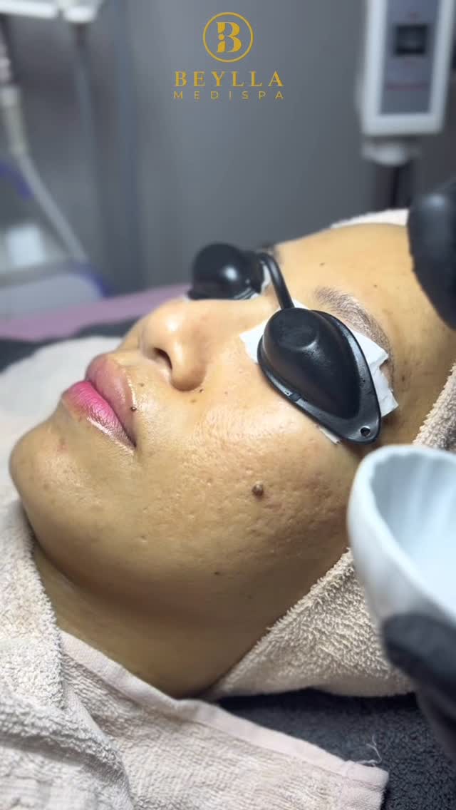 PARUT DEGIL? JANGAN STRESS! ๐ซถ๐ป
Parut jerawat berlubang yang dalam takkan hilang dengan skincare semata-mata ๐ฉ
Nak kulit lebih licin & flawless? Inilah rahsianya ๐๐ป TCA CROSS Treatment!
๐ฅ Rawatan fokus untuk parut berlubang (ice pick, box scar)
๐ Hasilnya? Parut makin naik, kulit makin sekata & licin!
๐ Proses cepat, hasil kekal โ makin hari makin cantik ๐
๐Beylla Medispa
๐ฒ DM sekarang untuk FREE consultation!
#TcaCross #TcaTreatment #ParutJerawat #RawatanParut #KulitLicin #JerawatBerlubang #ParutDegil #AcneScarRemoval