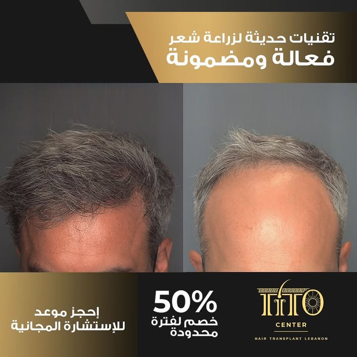 تقنية اليوم… نتائج تدوم لعمر.
في تيتو، نستخدم أجهزة متطورة وتقنيات عالمية لزراعة الشعر الطبيعي بأعلى دقة.
كل خطوة محسوبة، وكل نتيجة موثقة بشهادة رسمية.
مش مجرد زراعة… هذا استثمار في مظهرك.
Today’s tech, results that last.
At Tito, we use world-class technology and precision tools for natural hair transplants that look and stay real.
Every step is calculated. Every result certified.
#Titocenter #HairTech #HairTransplant #AdvancedTechnology #NaturalHair #HairRestoration #CertifiedResults #HairClinicExperts