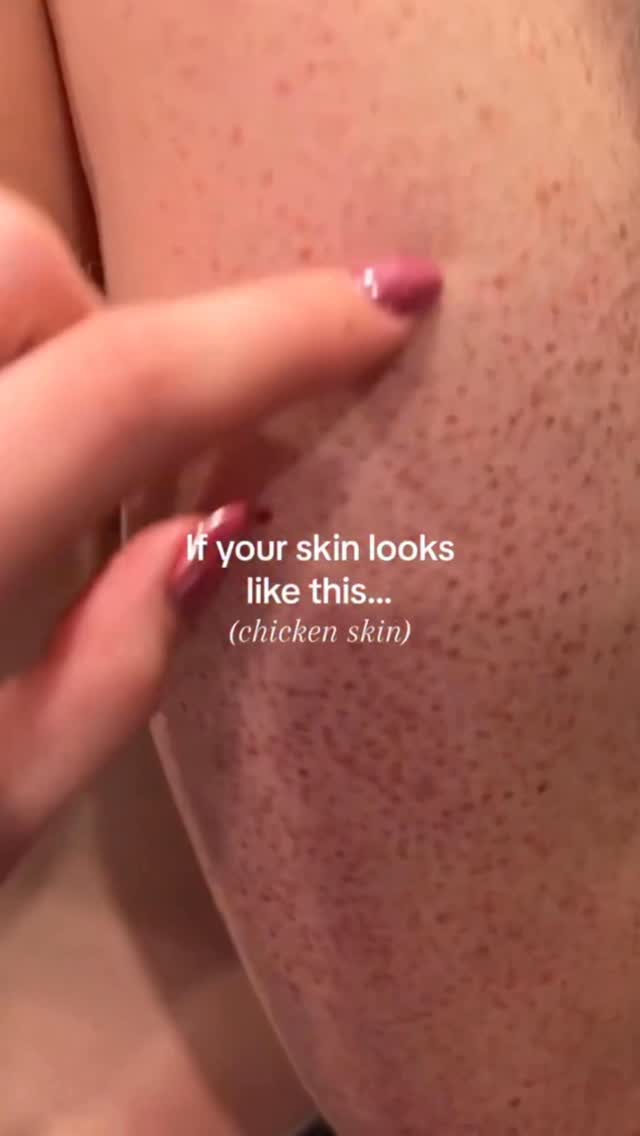 Keratosis pilaris, sometimes called “chicken skin,” is a common condition that causes rough bumps to appear on the skin. This combo, gently exfoliates and smooths the skin, helping to reduce bumps and reveal a softer, more even texture.
#keratosispilaris #bumpyskin #roughskin #skincare