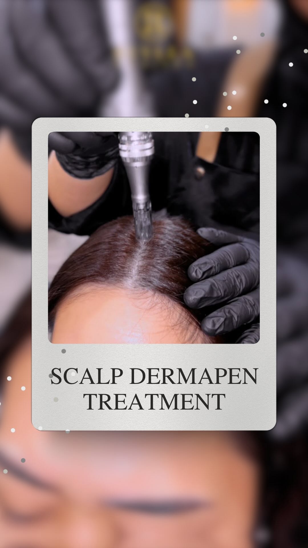 RAMBUT SEMAKIN NIPIS? ๐ฑ
Jangan tunggu botak baru nak bertindak! Rawat dari Akar dengan Scalp Dermapen Treatment ๐๐ปโโ๏ธ
Apa yang rawatan ni buat?
โ
Merangsang pertumbuhan rambut baru
โ
Kulit kepala lebih sihat, kurang keguguran
โ
Gunakan teknik microneedling dengan serum khas untuk scalp
๐ฑ Hasilnya?
โก๏ธ Akar rambut lebih kuat
โก๏ธ Rambut tumbuh lebih lebat & sihat
โก๏ธ Confidence pun naik bila rambut makin penuh! ๐๐บ
๐ Sesuai untuk lelaki & wanita
๐ฒ DM kami sekarang untuk consultation PERCUMA โ tak perlu tunggu rambut gugur teruk dulu!
#ScalpDermapen #RawatanRambut #RambutGugur #RawatanKulitKepala #HairGrowthTreatment