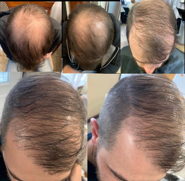 Chute de cheveux?
J'ai la solution pour toi ✨
Prend rendez-vous pour la cure complète ( 1 an sépare le début et la fin des photos)
#medavita
@coiffure_chickallure
