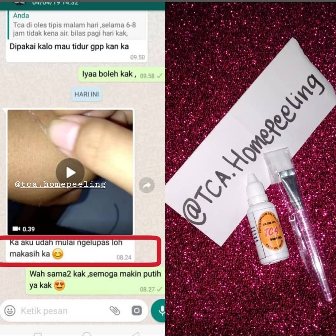 No PHP deh
Udah perwatan mahal dimana mana tapi ga mempan coba deh pakai TCA peeling ini