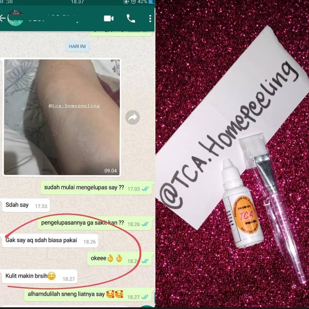 No PHP deh
Udah perwatan mahal dimana mana tapi ga mempan coba deh pakai TCA peeling ini