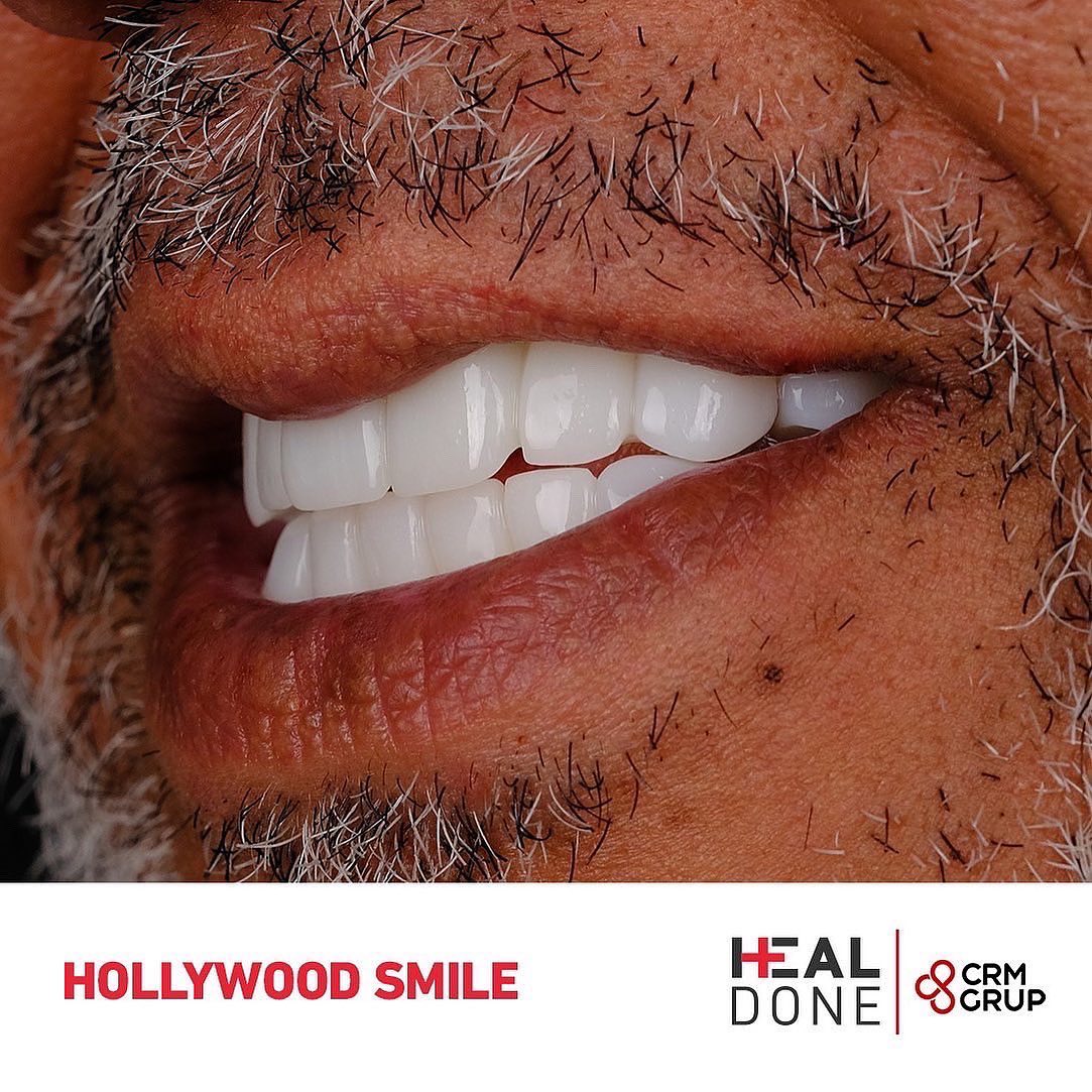 Une nouvelle forme du sourire c'est le premier pas vers un avenir meilleur.
Contactez-nous.
📞 +90 542 125 35 00
#hollywoodsmile #turkey #istanbul #implantsdentaires #turquie #traitementsdentaires
