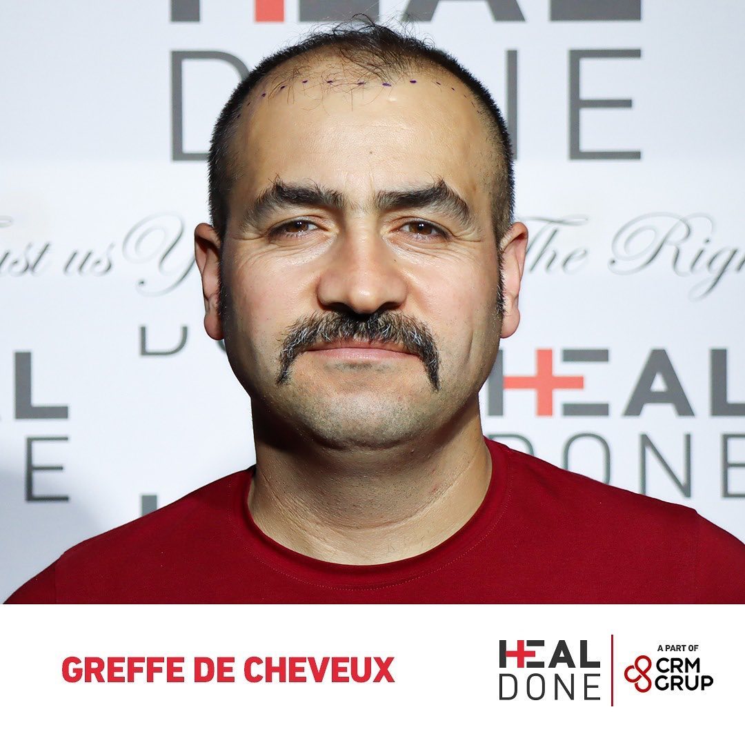 N'ayez pas peur de la calvitie !
Nous avons une solution pour vous!
Contactez-nous!
📞+90 542 125 35 00
#greffedecheveux #greffedecheveuxturquie #greffedecheveuxdhi #dhi #turquie #istanbul