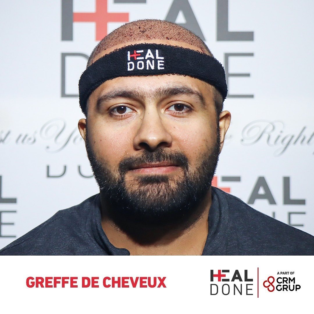 Le processus de greffe de cheveux offre une option plus fiable et permanente pour ceux qui souffrent de calvitie et de cheveux
Contactez-nous!
📞+90 542 125 35 00
#greffedecheveux #greffedecheveuxturquie #greffedecheveuxdhi #dhi #turquie #istanbul