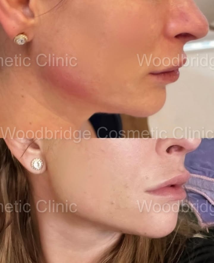 “Defined & Chiseled”
Jawline filler injections smooth wrinkles and fine lines, giving your face a more youthful appearance. These dermal fillers add shape,
volume and definition to thinning, saggy skin.
This nonsurgical cosmetic procedure offers noticeable, immediate results. Jawline filler
effects are temporary but can last years
#jawlinefiller#revanesse#lipfiller#botox#dysport#tox#nonsurgical#liquidbuttlift#chinfiller#pdothreads#mesotherapyinjections#fatburners#plasyicsurgery#instantbootys#cheekfiller#specialistsinfacerevisions#nonsurgicalnose#lipsbyluisa#costmecticinjectionists#wccbeauty#WCC