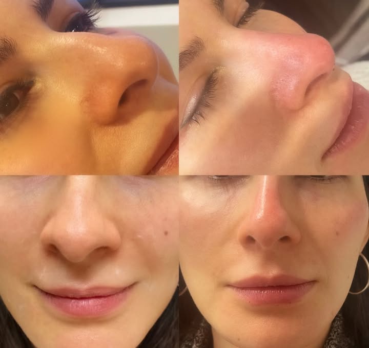 “ No Surgical Rhinoplasty “
REVANESSE Outline 💉
In the right hands, a non-surgical nose job can be used to reshape the nose and make subtle changes to the dorsum and tip
without the need for surgery. Such subtle improvements to the nasal contours can result in significant overall facial aesthetic improvements. Having worked as a surgical assist in the operating room during surgical rhinoplasty’s it as allowed me to have a very clear understanding of the anatomy of the nose which has allowed me to excel as a cosmetic injector . This also gives assurance to our patients that they are receiving treatment from safe and competent hands .
#nonsurgicalrhinoplasty#filler#botox#pdothreads#liquidbuttlift#liquidnose#revanesseinjectablesvaughn#injectablesetobicoke#injectablestoronto#wccbeauty#wcctraining#jawlinefiller#2023herewecome#newfacility#WCC