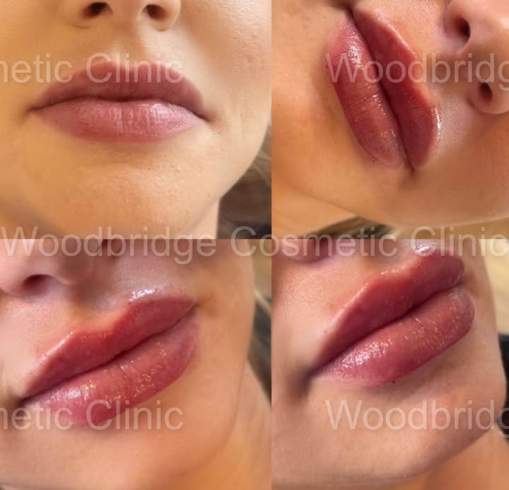 REVANESSE Kiss Please for that Sharp and Crisp Look
For a natural, clean feel with that gorgeous French Kiss finish, ask for @Revanesse Kiss . As one of our most popular products, Special Lips offers subtle
enhancement with just a touch of that 'je ne sais quoi" you're looking for 💋
#lipfiller#lipplump#naturallips#revanesse#pdothreads#mesotherapy#fatblasters#skinboosters#tox#botox#plasticsurgery#liquidbuttlift#wccbeauty#newlocationcomingsoon#podcast#lipplump#cheekfillers#pdo#nonsurgicalrhinoplasty#wccbeauty#wccnorth#wccsouth#wccwestcomingsoon#wcconestopshop#WCC