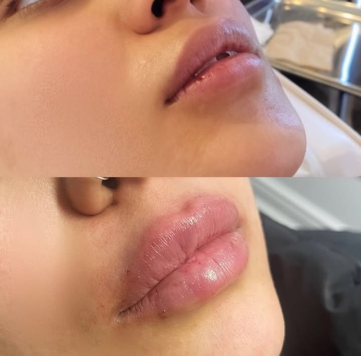 Mini Lip Plump @revanesse Outline For definition and Volume
A little goes a long way 👄
#lipfiller#lipplump#lips#revanesse#liquidbuttlift#lbl#botox#nonsurgicalnose#pdothreads#sculptra#plasticsurgery#plumped#lipstoronto#lipsetobicoke#newclinic#massage#lasers#trainingcentre#lipsvaughn#wccbeauty#wcc