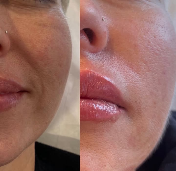 “Smile Lines Gone “
Soften and Rejuvenate with REVANESSE
#smilelinesgone#revanesse#facefiller#lessismore#pdothreads#nonsurgicalfacelift#botox#filler#medispa#trainingcentre#liquidbuttlift#liquidbooty#buttlift#tox#lipsvaughn#lipstoronto#lipsetobicoke#wccbeauty#wcc