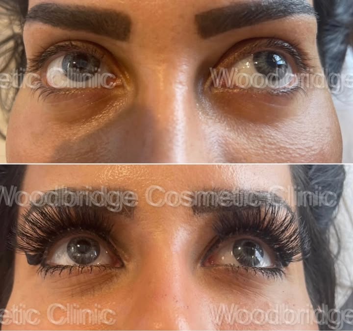“Refreshed and Rejuvenated “
One sentence that resonated with me from yesterday's clinic was-
"You inject happiness"
And I realized although i enjoy the procedures, the height of my enjoyment comes from a patients reaction to what can be a life changing.
#undereyefiller#revanesse#tox#pdothreads#lipfiller#lipfillertoronto#liquidbuttfiller#skinbooster#prp#lipfillertoronto#lipfilleretobicoke#plasticsurgery#wccbeauty#wcc