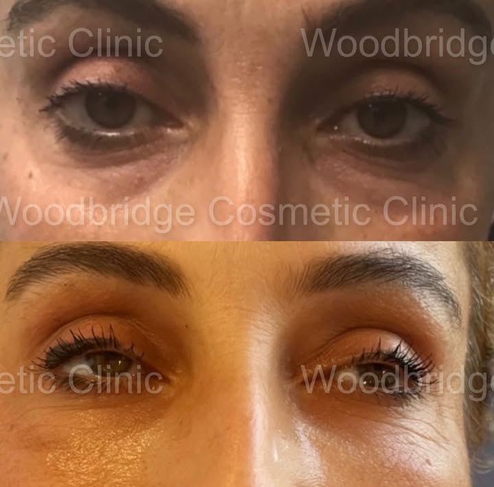 “Refreshed” 💉
Before and after under eyes rejuvenated
#undereyefiller#pdothreads#vaughnfiller#torontofiller#lipfiller#lips#liquidbuttlift#lbl#vaughnlips#nonsurgicalnose#nonsurgicalfacelift#plasticsurgery#wccbeauty#wcc