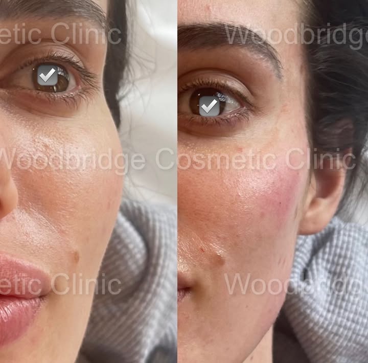 “Rejuvenate”
Youthful faces have a round or
oval appearance. As we age the temples hollow out . Revolumizing temples with fillers can help
restore the ideal facial shape, add youth, it provides an anchor point to help lift the rest of the face up.
#templefiller#lipfiller#pdothreads#botox#revanesse#nonsurgicalnosejob#liquidbuttlift#cosmeticinjectionist#plasticsurgery#trainingcentre#newthingscoming#exosomes#liquidgold#prpface#wccbeauty#wcc
