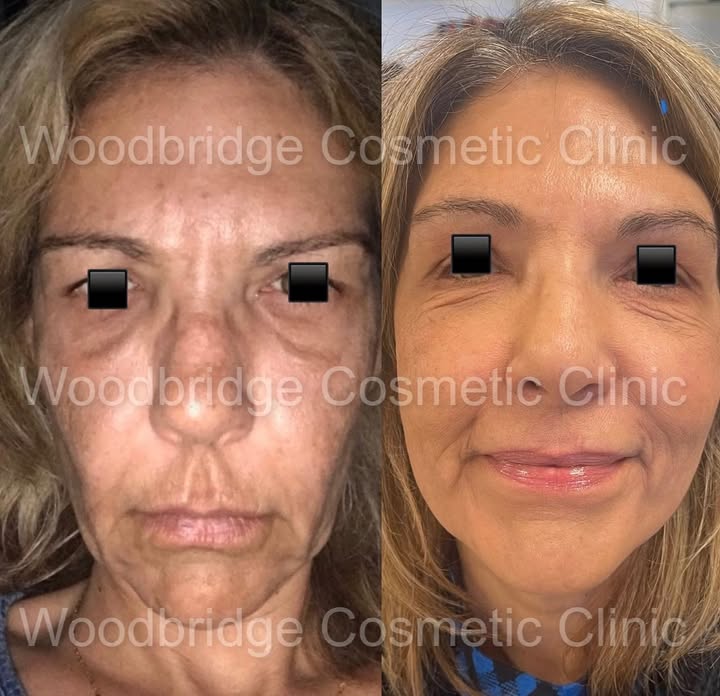 “ Transformation “
“Tailored made Packages “🤩
Each procedure is tailored to the client and it'll make your appearance seem sharpened, fresh and youthful while still looking natural.
#nonsurgicalfacelift#filler#tox#vaughninjectables#snacthedpackage#pdothreads#sculptra#revanesse#fillerstoronto#medispa#laser#liquidbuttlift#liquidhiplift#liquidbreastlift#lipfillervaughn#cosmeticinjectionistLuisa#wccbeauty#Wccnorth#wccsouth#wccwest#newlocationsinthemaking#trainingcentre#WCC