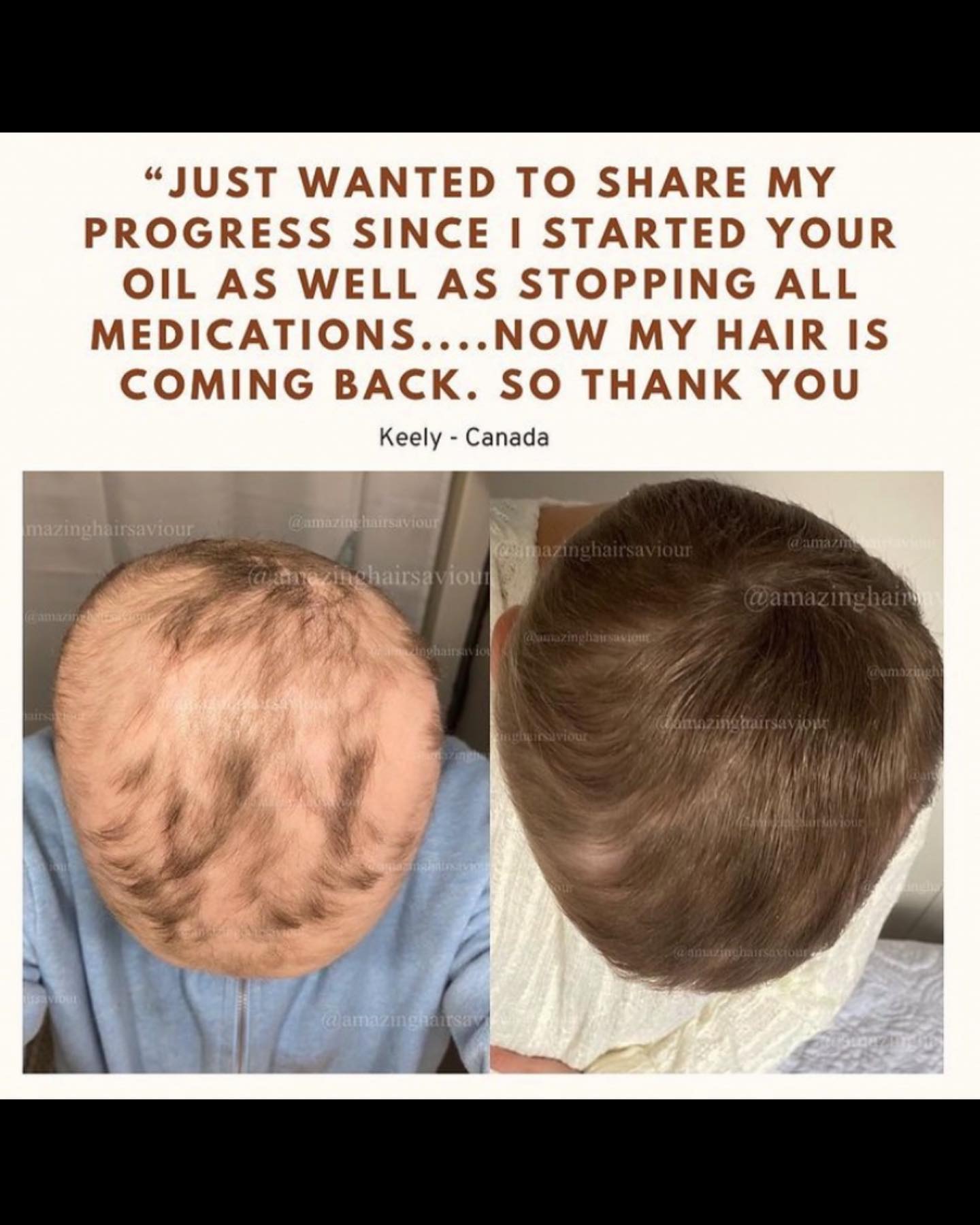 Slide to see more results 😍
All thanks to Amazing Hair Saviour ❤️
In love with your incredible results 🤩
Let’s get growing
www.amazinghairsaviour.com
#hairgrowth #hairgrowthtips #hairgrowthoil #hairgrowthjourney #hairgrowthproducts #hairgram #hairgoal #hairgrowthserum #hairloss #hairlosstreatment #hairlosshelp #hairlosssolutions #hairlosssolution #hairlossspecialist #postpartumhairloss #alopecia #alopeciaareata #amazinghairsaviour #sephoracanada #sephora