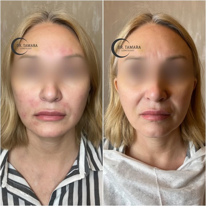 Комплексная работа по лицу💉
Ботулотоксин Full Face
Контурная пластика губ
Контурная пластика средней трети
Контурная пластика нижней трети