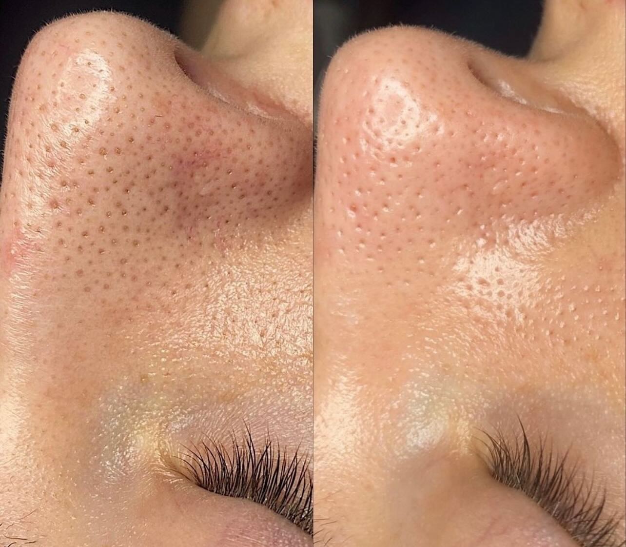 Hydrafacial Results‼️🥇What Is A Hydrafacial? A hydrafacial is one of the most powerful, non-invasive skin resurfacing treatments available today. It combines cleansing, exfoliation, extraction, hydration and antioxidant protection that removes dead skin cells and impurities, while simultaneously delivering moisturizing serums into the skin #hydrafacial#hydrafacialciltbakımı#whetstone#london#barnet#beauty#facialtreatment