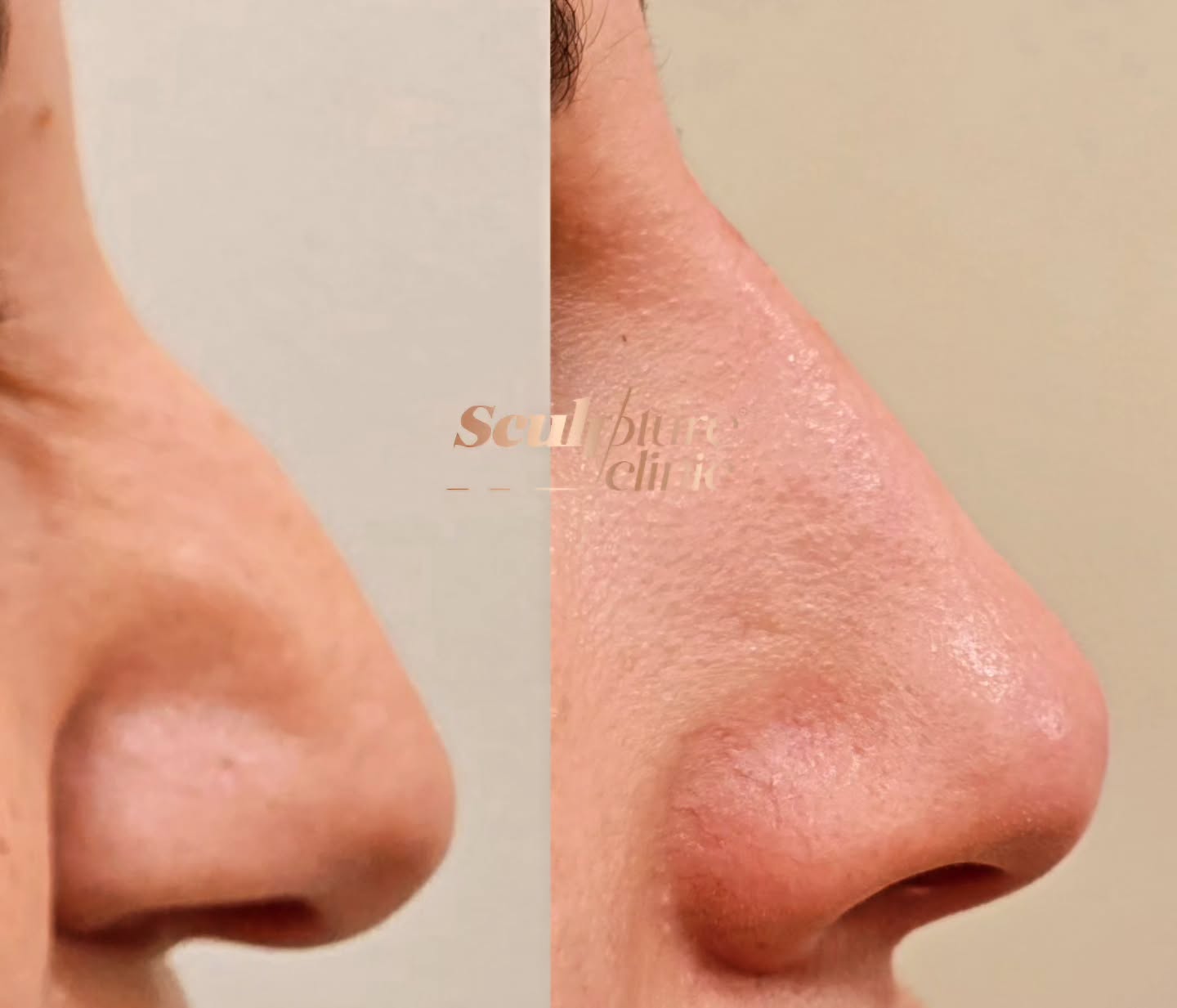 5 mins Nose job for a more refined and balanced profile
Exclusively available in Sculpture clinic
Pain level: Tolerable (Local anesthesia)
Recovery: no downtime
📝Note: Individual results may vary
⚠️Caution: Must be performed by an experienced Doctor
Follow us on
📸Instagram: Maged_Rizkallah
♦️Youtube Channel: Dr Maged Rizkallah
For more info and reservations
📧Email: Info@sculpture-clinic.com
🌍Website: www.sculpture-clinic.com
☎️Phone : +20106-292-6666
Due to high calls volume, please leave a message if your call is not answered immediately.
© Copyright 2016-2024 by Dr Maged Rizkallah and Sculpture Clinic
#sculptureclinic #drmagedrizkallah #askDrMaged #nose #nonsurgical #beauty #beautiful #NonsurgicalNoseFiller
#NonInvasiveRhinoplasty
#NoseEnhancementWithoutSurgery
#LiquidRhinoplasty
#HyaluronicAcidNoseFillers
#NoseFillerTransformation
#NaturalNoseContouring
#SafeNoseAugmentation
#ImprovedNasalProfile
#SubtleNoseReshaping
#PainFreeNoseJob