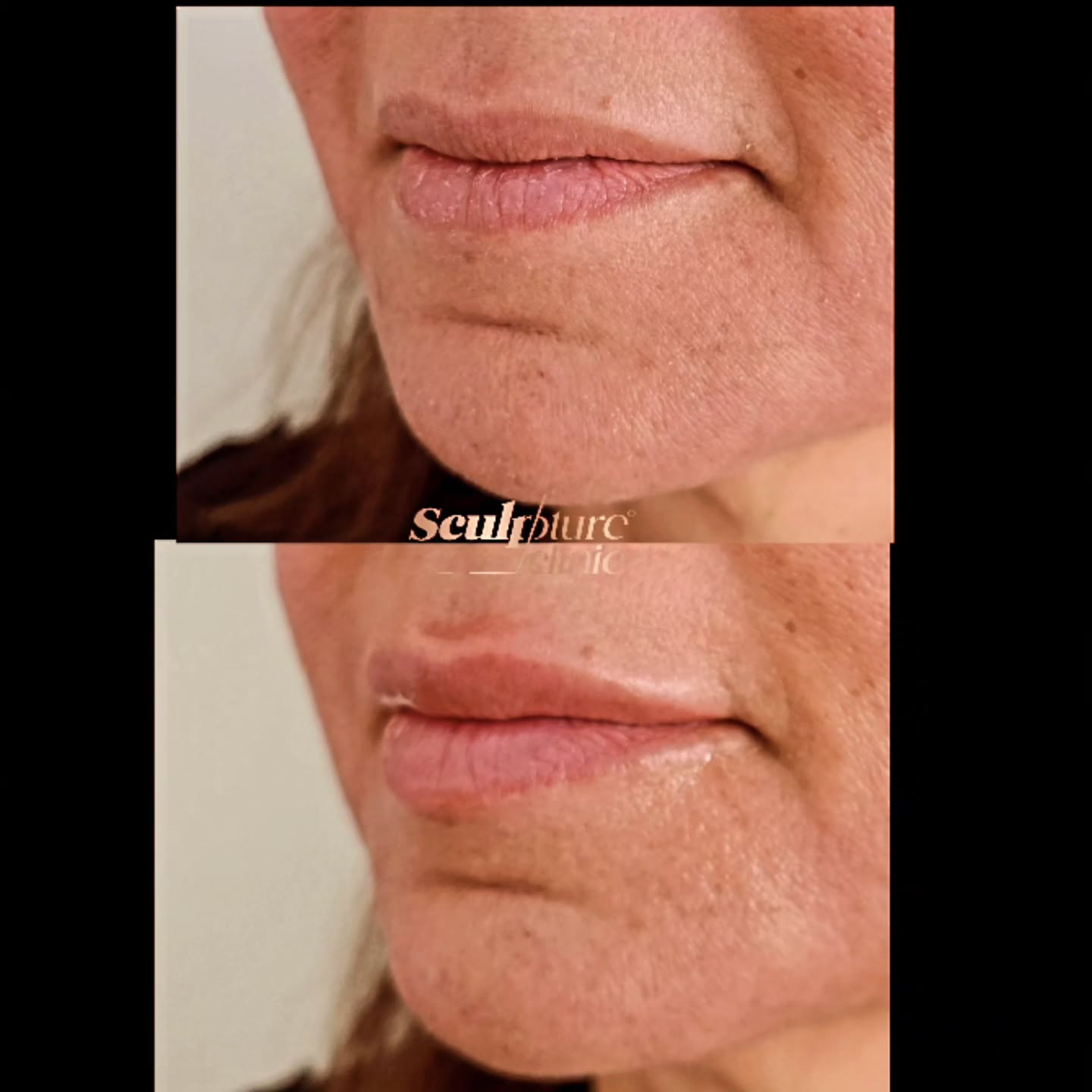 Hydrated & healthy
Hyaluronic acid-based fillers keep your lips hydrated and healthy-looking. Exclusively available in Sculpture clinic
Pain level: Tolerable (Local anesthesia)
Recovery: no downtime
📝Note: Individual results may vary
⚠️Caution: Must be performed by an experienced Doctor
Follow us on
📸Instagram: Maged_Rizkallah
♦️Youtube Channel: Dr Maged Rizkallah
For more info and reservations
📧Email: Info@sculpture-clinic.com
🌍Website: www.sculpture-clinic.com
☎️Phone : +20106-292-6666
Due to high calls volume, please leave a message if your call is not answered immediately.
© Copyright 2016-2024 by Dr Maged Rizkallah and Sculpture Clinic
#LipFillers #LipAugmentation #LipInjections
#LipEnhancement #FullerLips #VoluptuousLips
#KissableLips #LipGoals #LipTransformation #LipFillerResults #LipFillerBeforeAndAfter
#LipFillerJourney #LipFillerLove #LipFillerAddict
#LipFillerQueen #NaturalLipFillers #SafeLipFillers #LipFillerSpecialist #LipFillerClinic #lipfillerdeals #LipFillerSpecial #askdrmaged