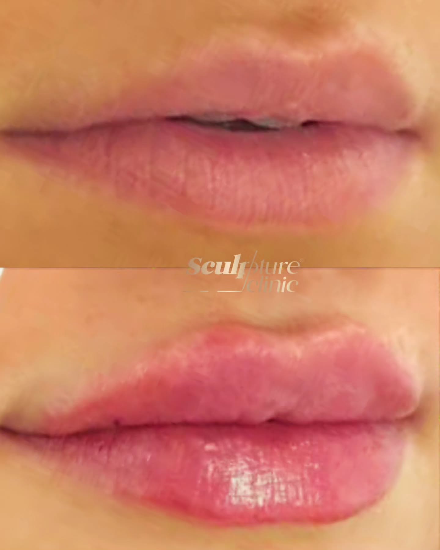 Hydrated & healthy
Hyaluronic acid-based fillers keep your lips hydrated and healthy-looking. Exclusively available in Sculpture clinic
Pain level: Tolerable (Local anesthesia)
Recovery: no downtime
📝Note: Individual results may vary
⚠️Caution: Must be performed by an experienced Doctor
Follow us on
📸Instagram: Maged_Rizkallah
♦️Youtube Channel: Dr Maged Rizkallah
For more info and reservations
📧Email: Info@sculpture-clinic.com
🌍Website: www.sculpture-clinic.com
☎️Phone : +20106-292-6666
Due to high calls volume, please leave a message if your call is not answered immediately.
© Copyright 2016-2024 by Dr Maged Rizkallah and Sculpture Clinic
#LipFillers #LipAugmentation #LipInjections
#LipEnhancement #FullerLips #VoluptuousLips
#KissableLips #LipGoals #LipTransformation #LipFillerResults #LipFillerBeforeAndAfter
#LipFillerJourney #LipFillerLove #LipFillerAddict
#LipFillerQueen #NaturalLipFillers #SafeLipFillers #LipFillerSpecialist #LipFillerClinic #lipfillerdeals #LipFillerSpecial #askdrmaged